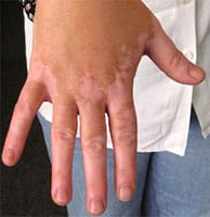 Vitiligo Disease